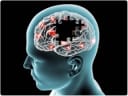 Bumetanide considered effective in the treatment of genetic Alzheimer's by the end of 2026?