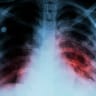 How many tuberculosis cases will be reported in the United States in 2026?